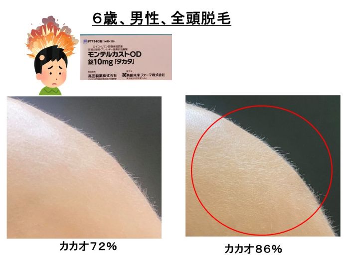 円形脱毛症　病院